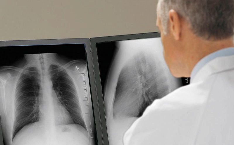 AKC (akciğer grafisi)